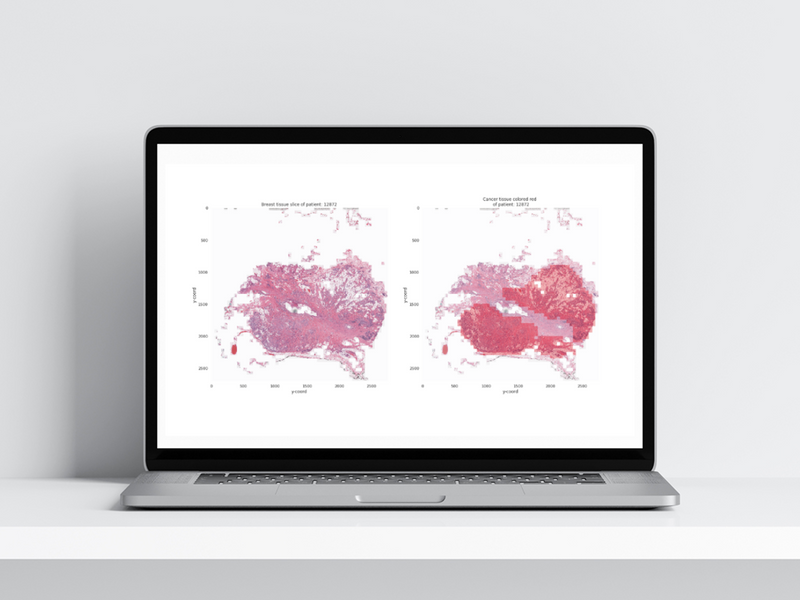 Breast Cancer Predicting